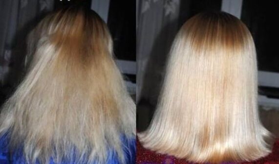 Before and after hair restoration