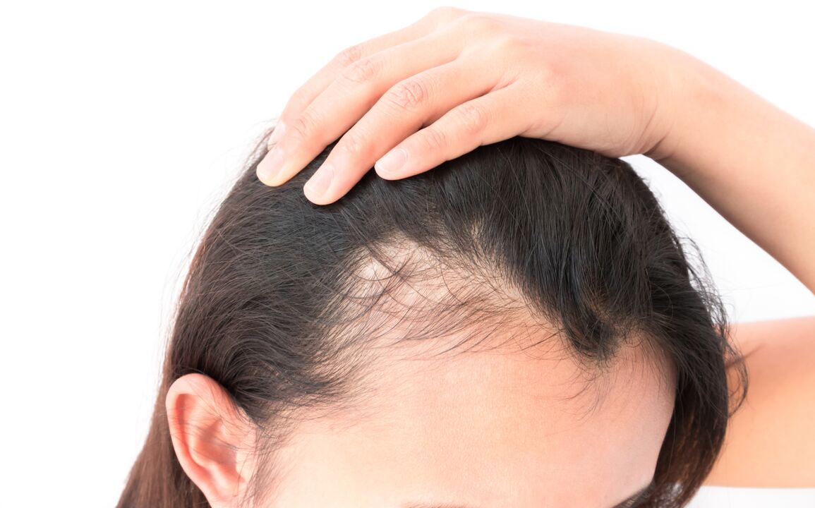 baldness and hair restoration spray Trichomist Forte